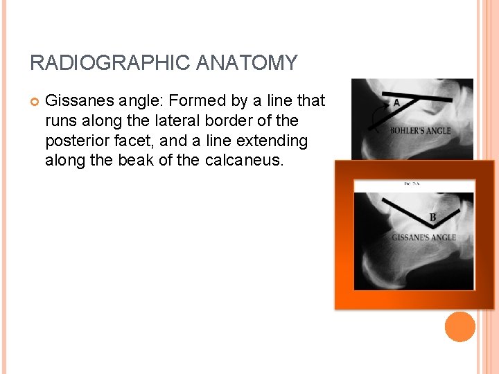 RADIOGRAPHIC ANATOMY Gissanes angle: Formed by a line that runs along the lateral border