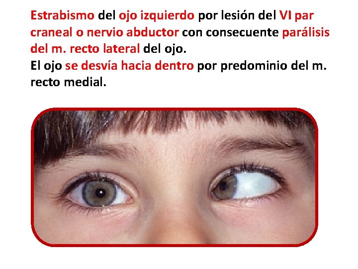 Estrabismo del ojo izquierdo por lesión del VI par craneal o nervio abductor consecuente