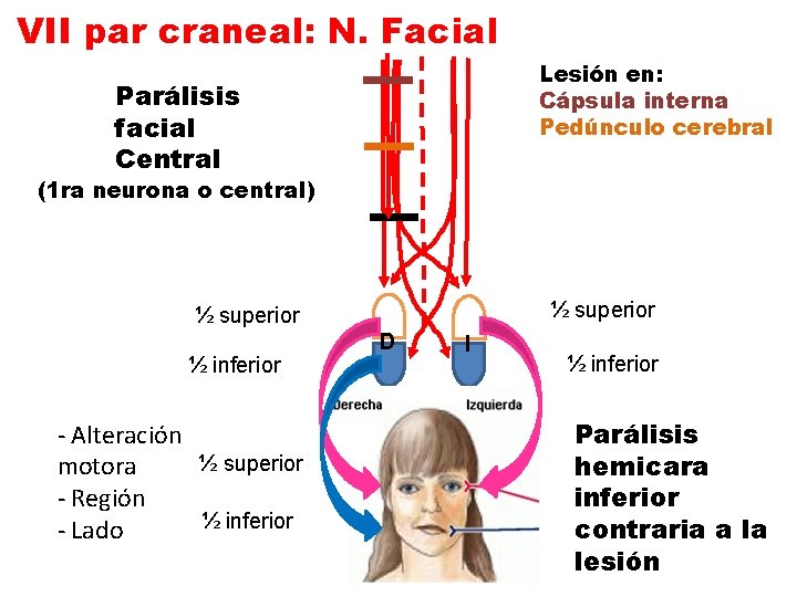 VII par craneal: N. Facial Lesión en: Cápsula interna Pedúnculo cerebral Parálisis facial Central
