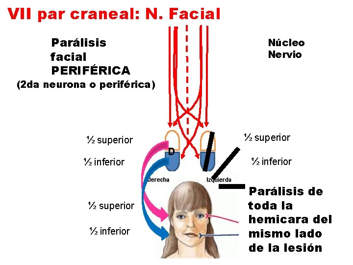 VII par craneal: N. Facial Parálisis facial PERIFÉRICA Núcleo Nervio (2 da neurona o