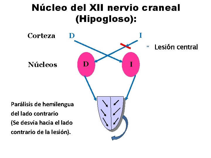 Núcleo del XII nervio craneal (Hipogloso): Corteza I D Núcleos Parálisis de hemilengua del