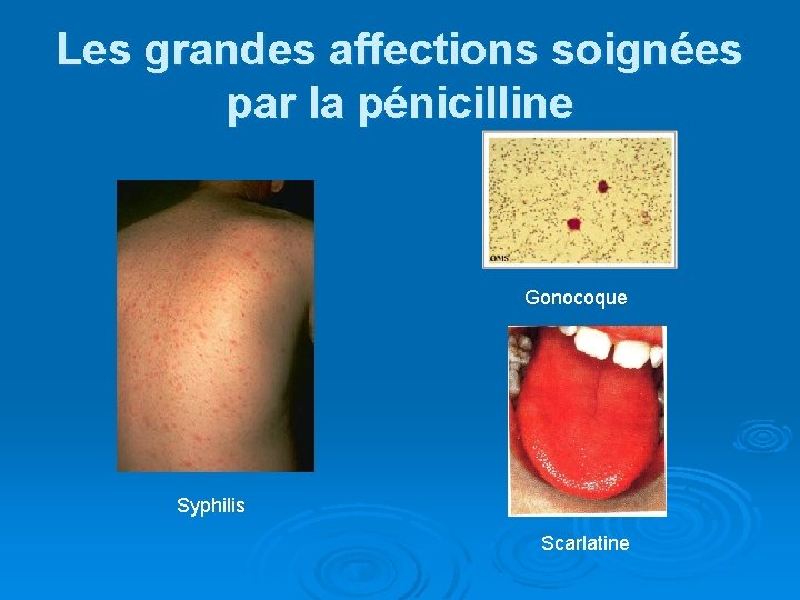 Les grandes affections soignées par la pénicilline Gonocoque Syphilis Scarlatine 
