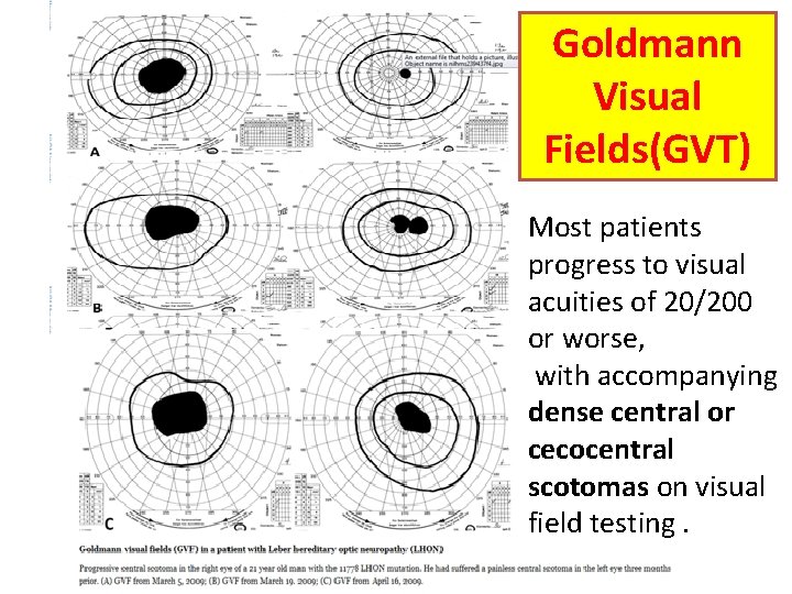 Goldmann Visual Fields(GVT) Most patients progress to visual acuities of 20/200 or worse, with