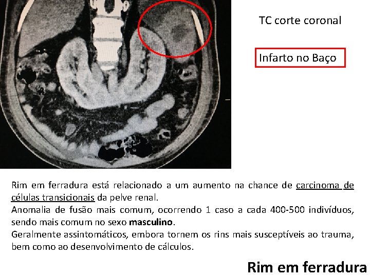 TC corte coronal Infarto no Baço Rim em ferradura está relacionado a um aumento
