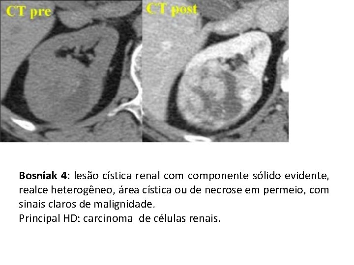 Bosniak 4: lesão cística renal componente sólido evidente, realce heterogêneo, área cística ou de