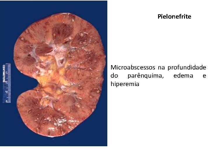 Pielonefrite Microabscessos na profundidade do parênquima, edema e hiperemia 