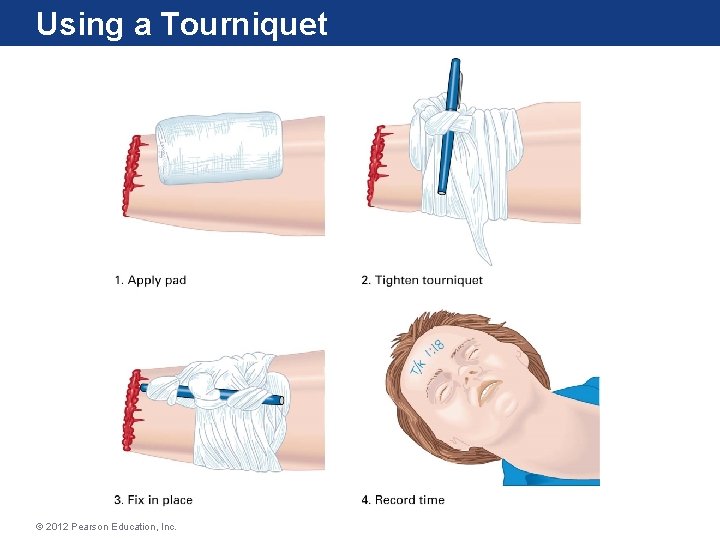 Using a Tourniquet © 2012 Pearson Education, Inc. 