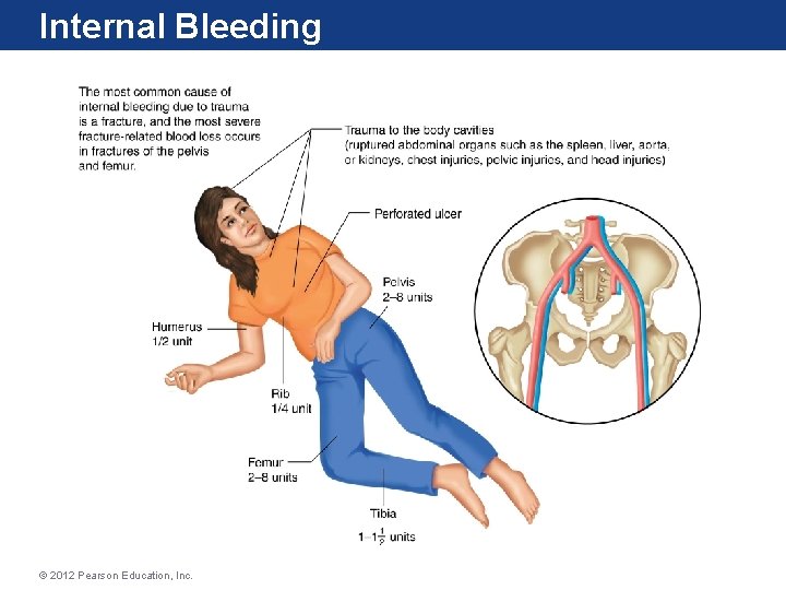 Internal Bleeding © 2012 Pearson Education, Inc. 