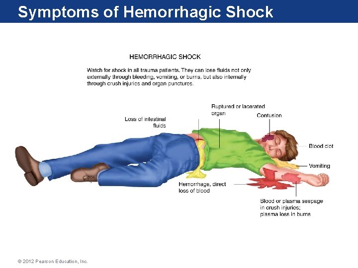 Symptoms of Hemorrhagic Shock © 2012 Pearson Education, Inc. 