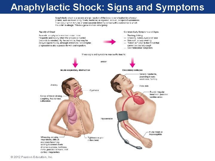 Anaphylactic Shock: Signs and Symptoms © 2012 Pearson Education, Inc. 