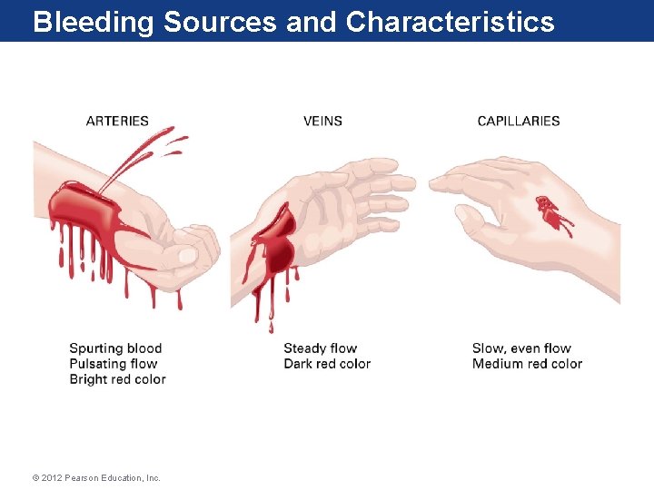 Bleeding Sources and Characteristics © 2012 Pearson Education, Inc. 