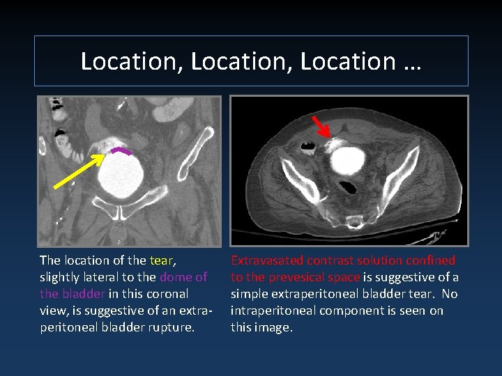 Location, Location … The location of the tear, slightly lateral to the dome of