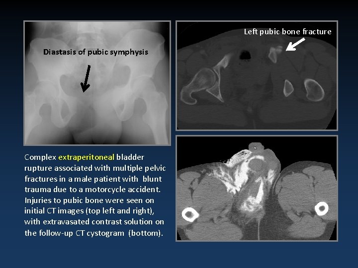 Left pubic bone fracture Diastasis of pubic symphysis Complex extraperitoneal bladder rupture associated with