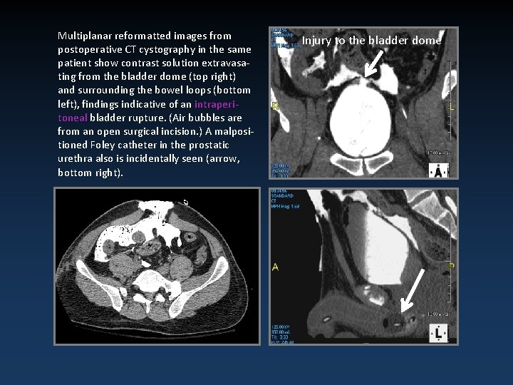 Multiplanar reformatted images from postoperative CT cystography in the same patient show contrast solution