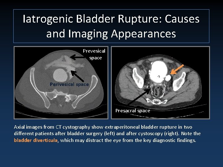 Iatrogenic Bladder Rupture: Causes and Imaging Appearances Prevesical space Perivesical space Presacral space Axial