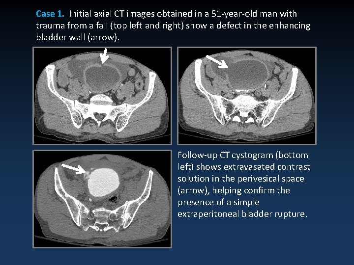 Case 1. Initial axial CT images obtained in a 51 -year-old man with trauma