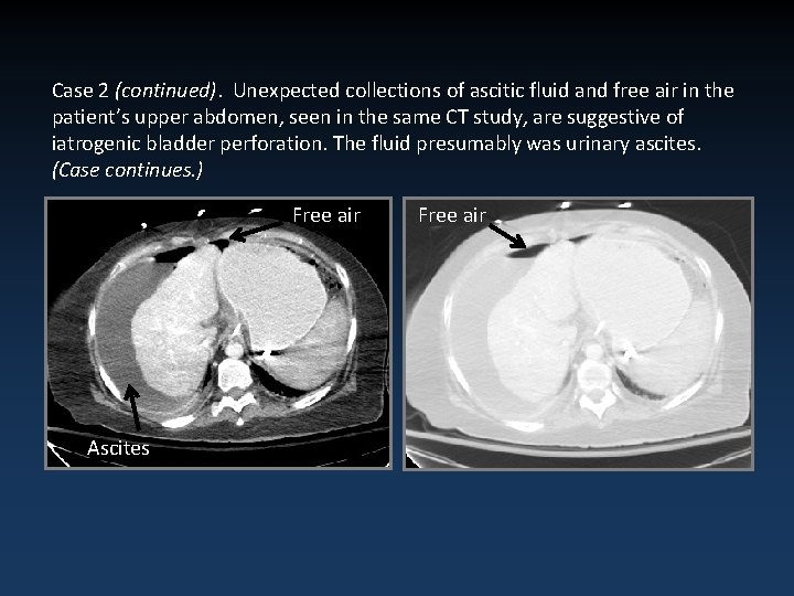 Case 2 (continued). Unexpected collections of ascitic fluid and free air in the patient’s