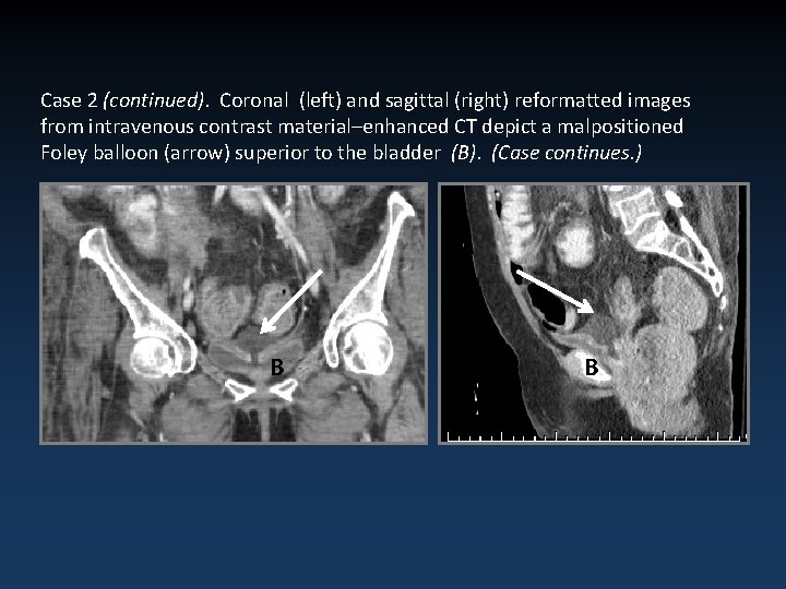 Case 2 (continued). Coronal (left) and sagittal (right) reformatted images from intravenous contrast material–enhanced