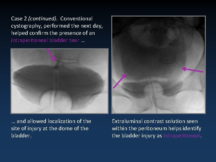Case 2 (continued). Conventional cystography, performed the next day, helped confirm the presence of