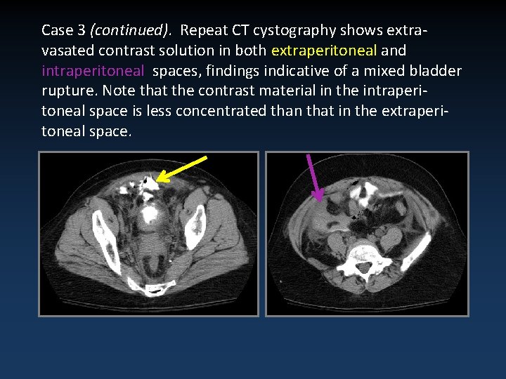 Case 3 (continued). Repeat CT cystography shows extravasated contrast solution in both extraperitoneal and