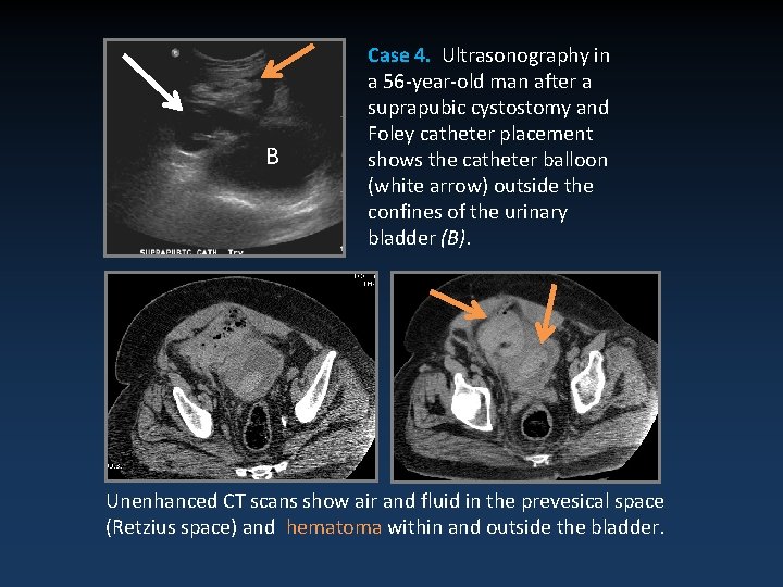 B Case 4. Ultrasonography in a 56 -year-old man after a suprapubic cystostomy and