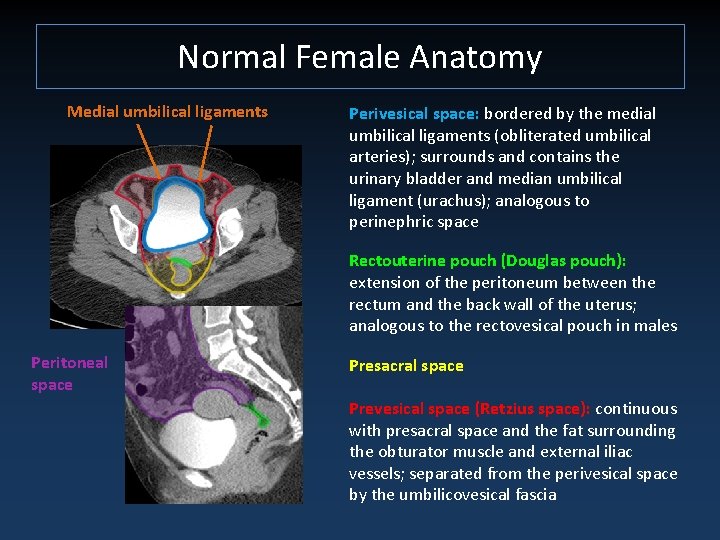 Normal Female Anatomy Medial umbilical ligaments Perivesical space: bordered by the medial umbilical ligaments