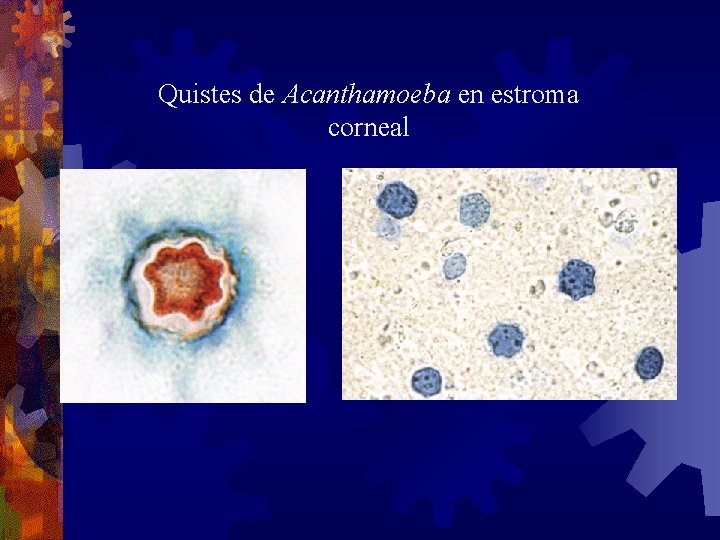 Quistes de Acanthamoeba en estroma corneal 