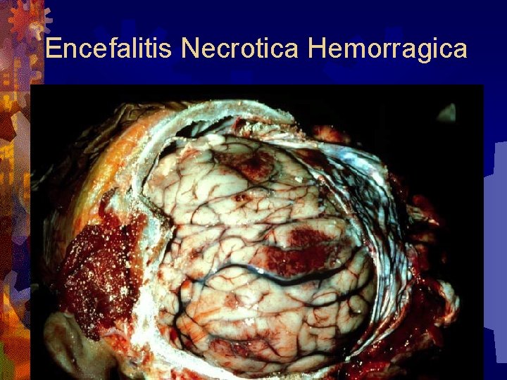Encefalitis Necrotica Hemorragica 