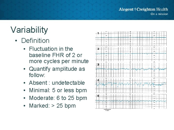 Variability • Definition • Fluctuation in the baseline FHR of 2 or more cycles