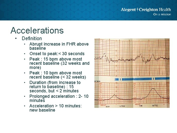 Accelerations • Definition • Abrupt increase in FHR above baseline • Onset to peak: