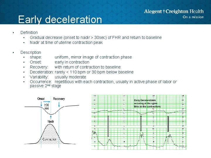 Early deceleration • Definition • Gradual decrease (onset to nadir > 30 sec) of