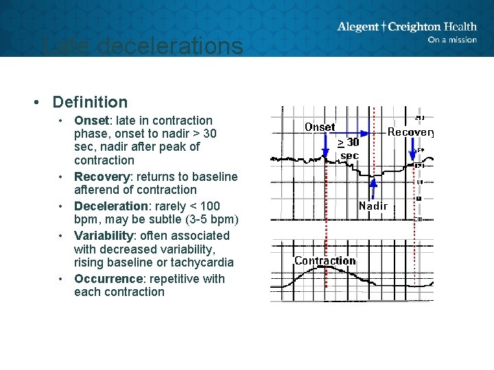 Late decelerations • Definition • Onset: late in contraction phase, onset to nadir >