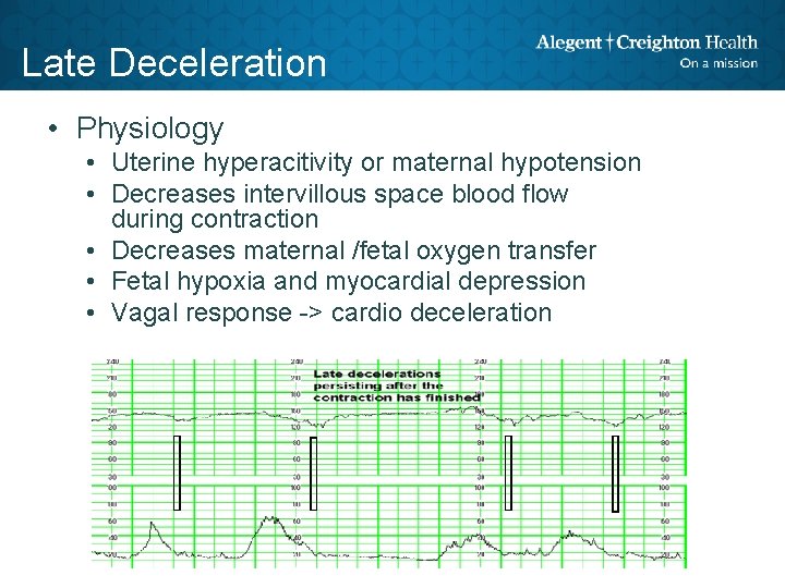 Late Deceleration • Physiology • Uterine hyperacitivity or maternal hypotension • Decreases intervillous space