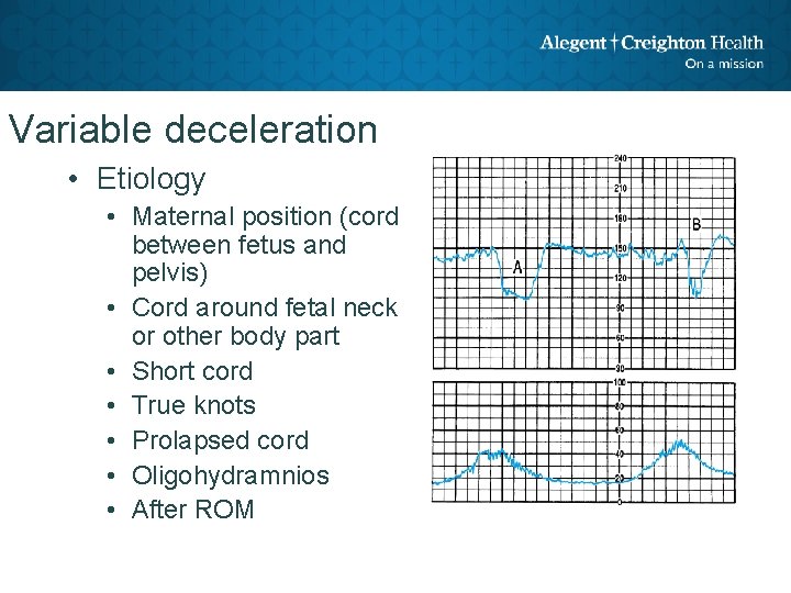 Variable deceleration • Etiology • Maternal position (cord between fetus and pelvis) • Cord