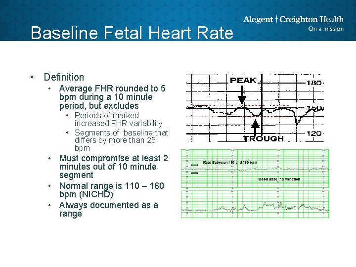 Baseline Fetal Heart Rate • Definition • Average FHR rounded to 5 bpm during