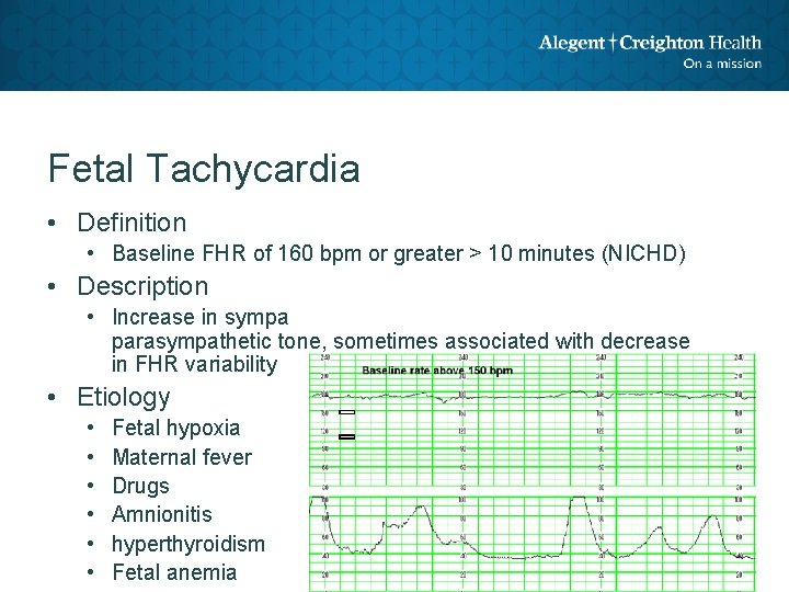 Fetal Tachycardia • Definition • Baseline FHR of 160 bpm or greater > 10