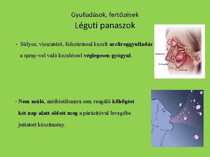 Gyulladások, fertőzések Léguti panaszok - Súlyos, visszatérő, felszúrással kezelt arcüreggyulladás a spray-vel való kezeléssel