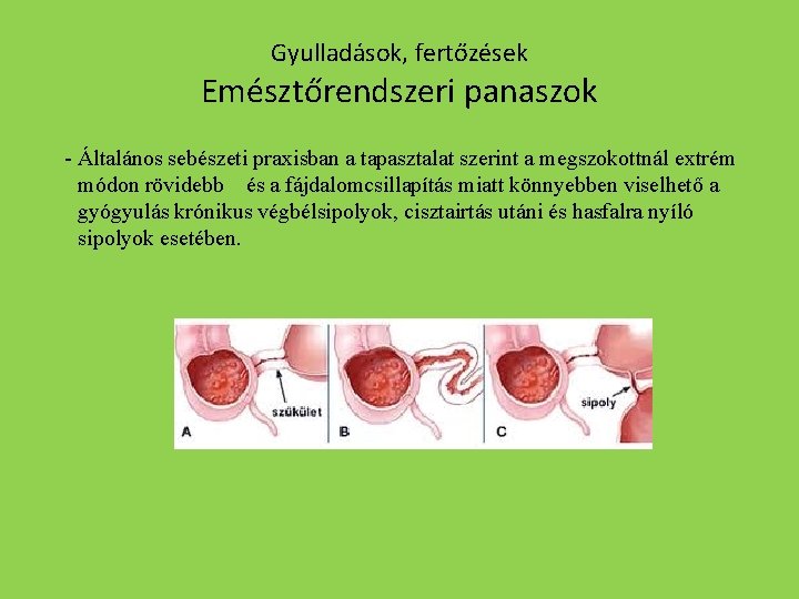 Gyulladások, fertőzések Emésztőrendszeri panaszok - Általános sebészeti praxisban a tapasztalat szerint a megszokottnál extrém