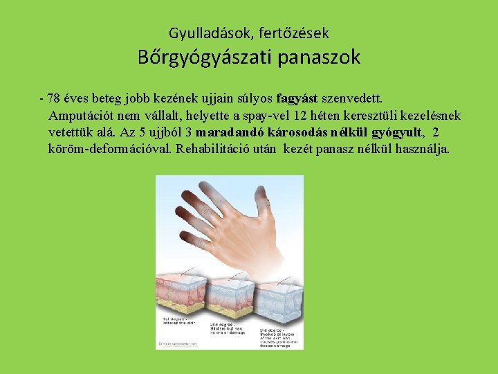 Gyulladások, fertőzések Bőrgyógyászati panaszok - 78 éves beteg jobb kezének ujjain súlyos fagyást szenvedett.