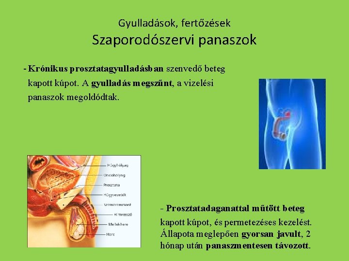 Gyulladások, fertőzések Szaporodószervi panaszok - Krónikus prosztatagyulladásban szenvedő beteg kapott kúpot. A gyulladás megszűnt,