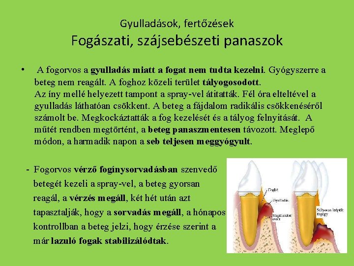 Gyulladások, fertőzések Fogászati, szájsebészeti panaszok • A fogorvos a gyulladás miatt a fogat nem