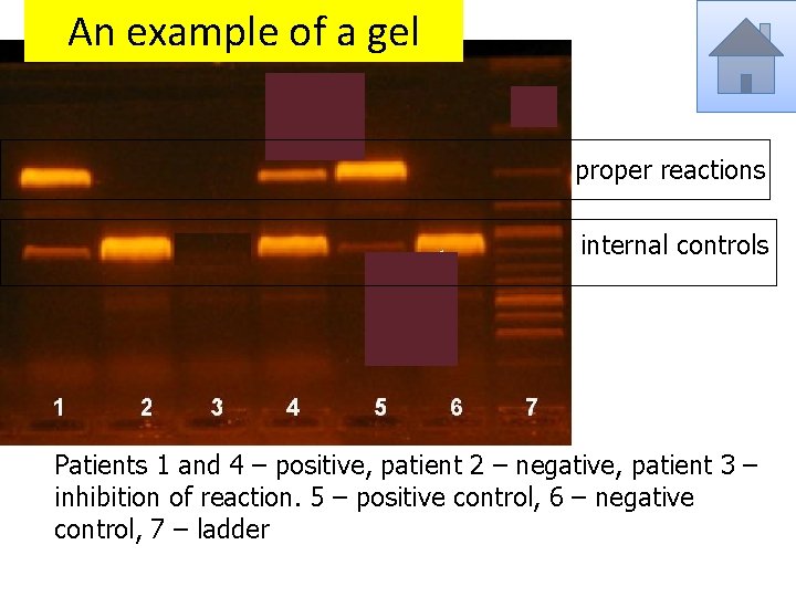 An example of a gel proper reactions internal controls Patients 1 and 4 –