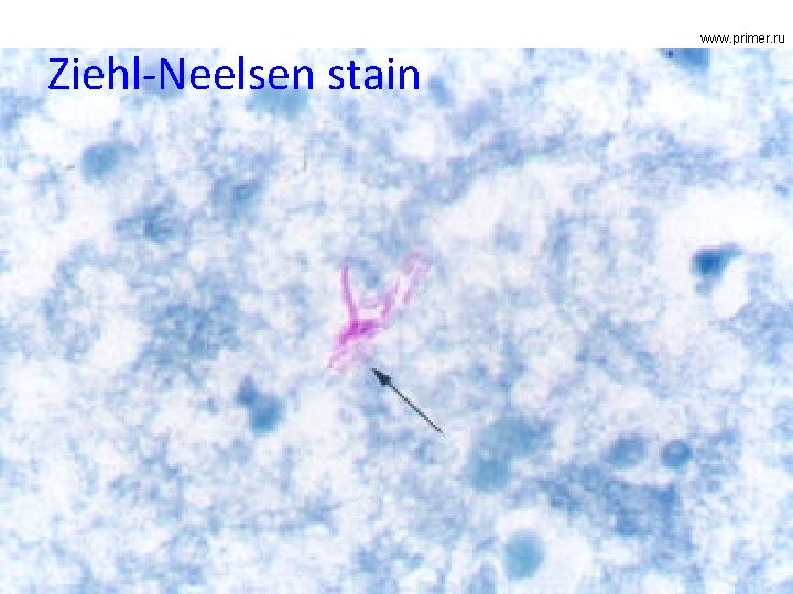 Ziehl-Neelsen stain www. primer. ru 