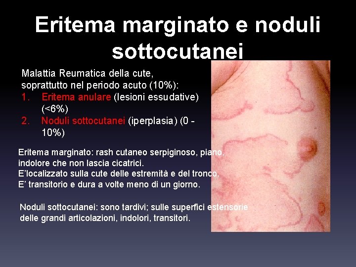 Eritema marginato e noduli sottocutanei Malattia Reumatica della cute, soprattutto nel periodo acuto (10%):
