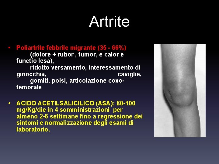 Artrite • Poliartrite febbrile migrante (35 - 66%) (dolore + rubor , tumor, e