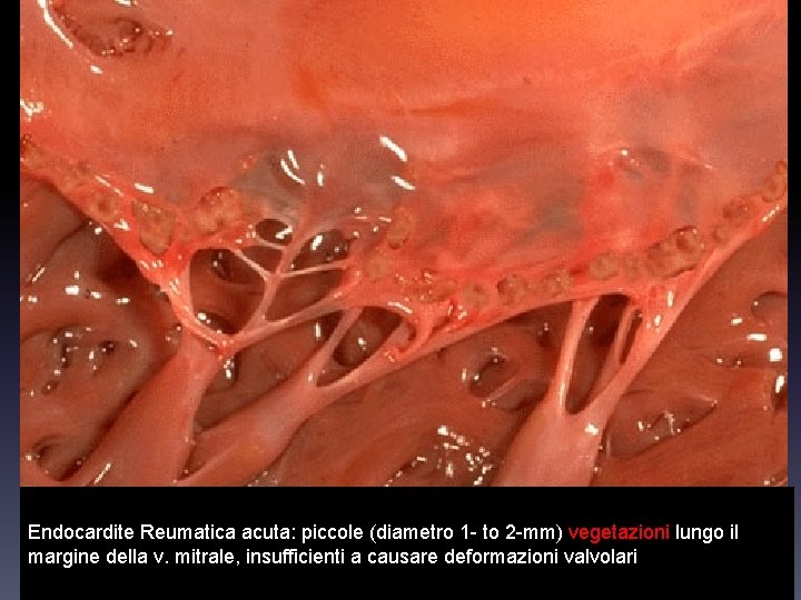Endocardite Reumatica acuta: piccole (diametro 1 - to 2 -mm) vegetazioni lungo il margine