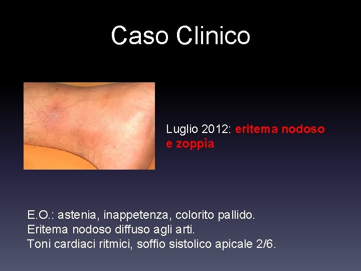 Caso Clinico Luglio 2012: eritema nodoso e zoppìa E. O. : astenia, inappetenza, colorito