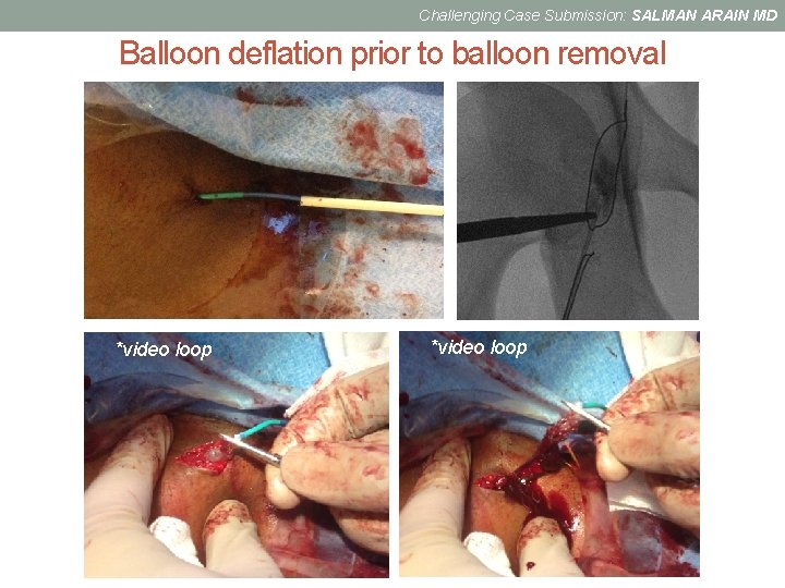 Challenging Case Submission: SALMAN ARAIN MD Balloon deflation prior to balloon removal *video loop