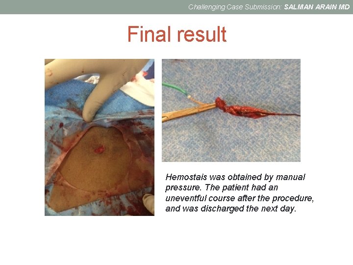 Challenging Case Submission: SALMAN ARAIN MD Final result Hemostais was obtained by manual pressure.