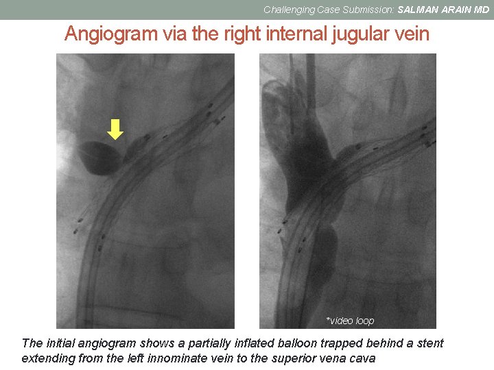 Challenging Case Submission: SALMAN ARAIN MD Angiogram via the right internal jugular vein *video